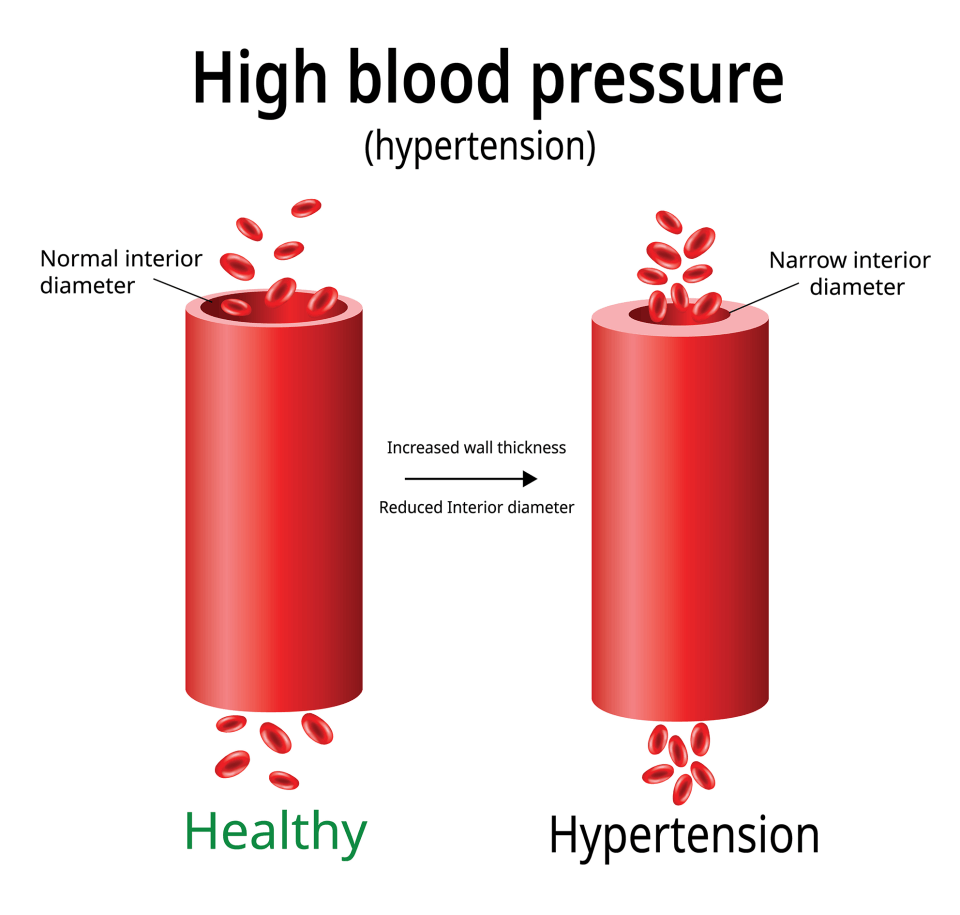 The Blood Pressure Program